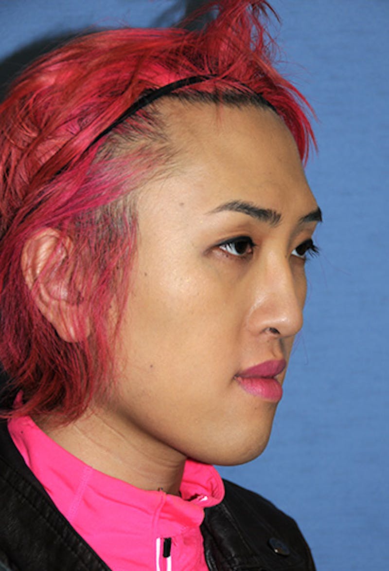Chin Implant Reshaping Before & After Gallery - Patient 270393 - Image 3