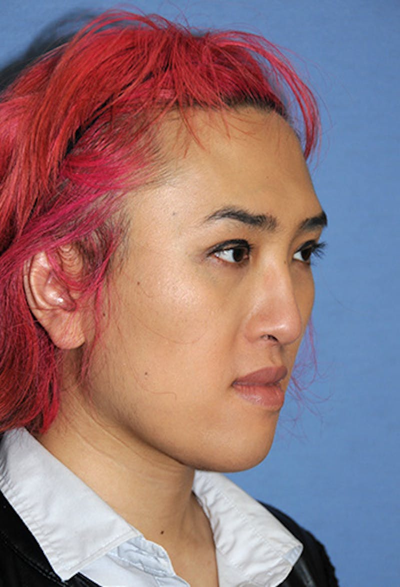 Chin Implant Reshaping Before & After Gallery - Patient 270393 - Image 4