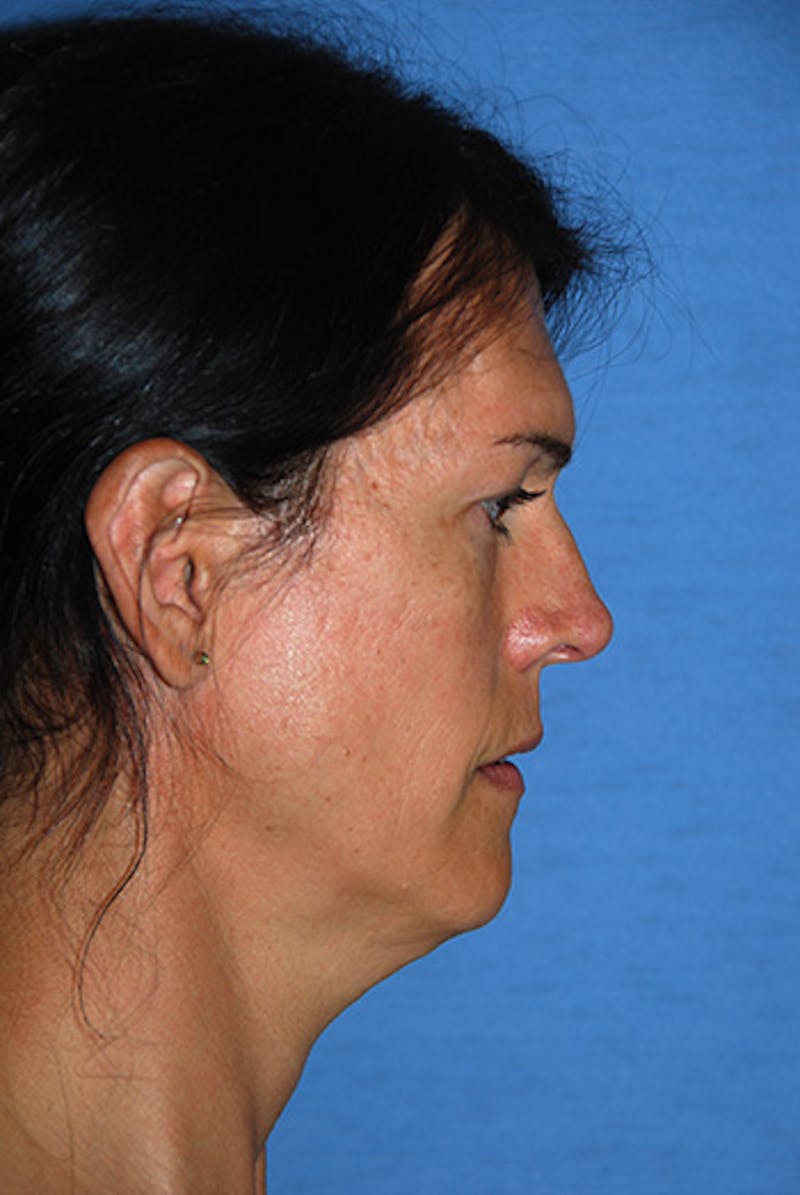 Transgender Surgery Before & After Gallery - Patient 270382 - Image 3