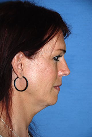 Chin Implant Reshaping Before & After Gallery - Patient 300127 - Image 4