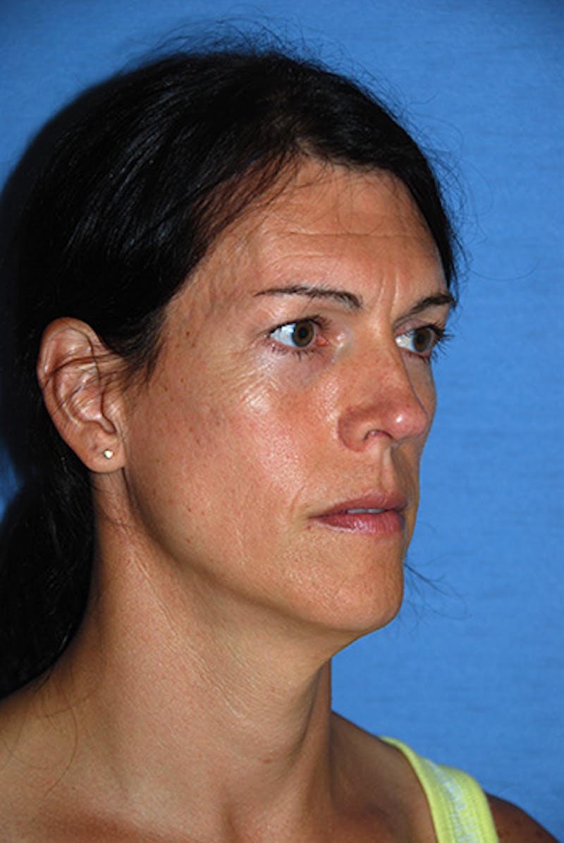Transgender Surgery Before & After Gallery - Patient 270382 - Image 5