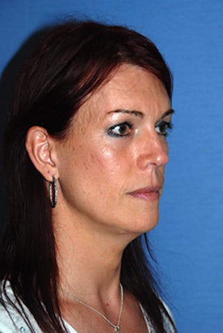 Chin Implant Reshaping Before & After Gallery - Patient 300127 - Image 6