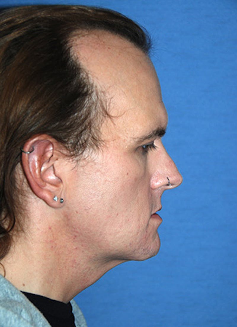 Transgender Surgery Before & After Gallery - Patient 263469 - Image 5