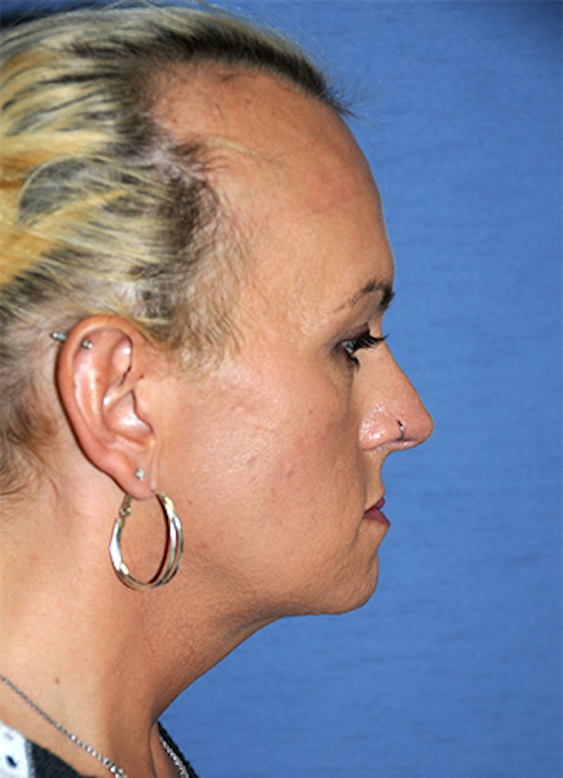 Transgender Surgery Before & After Gallery - Patient 263469 - Image 6