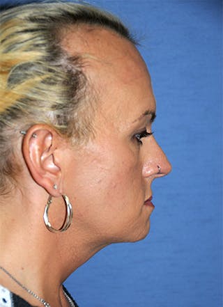 Transgender Surgery Before & After Gallery - Patient 263469 - Image 6
