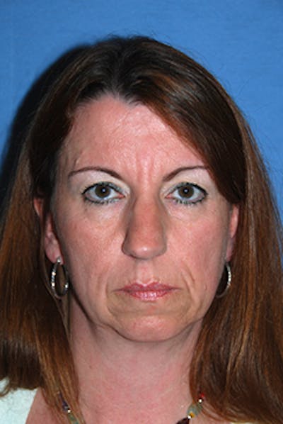 Rhinoplasty Before & After Gallery - Patient 346211 - Image 1
