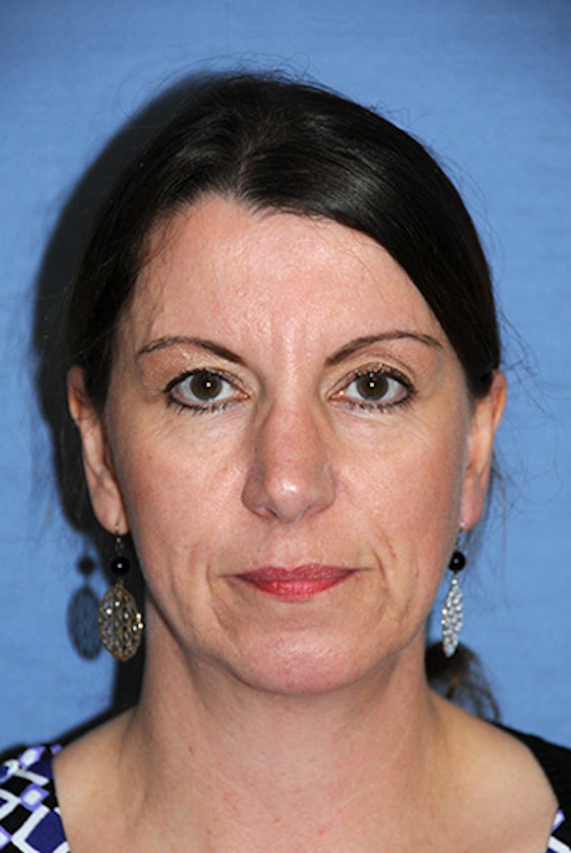 Chin Implant Reshaping Before & After Gallery - Patient 396025 - Image 2
