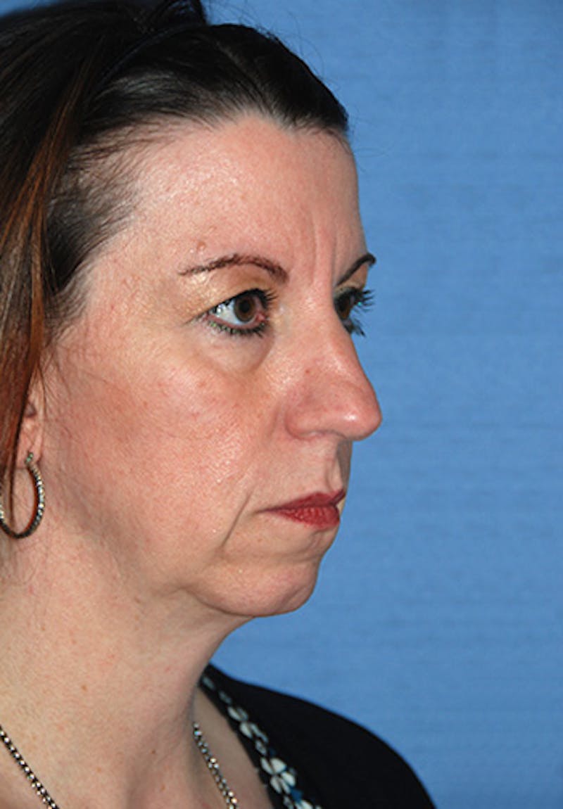 Chin Implant Reshaping Before & After Gallery - Patient 396025 - Image 3