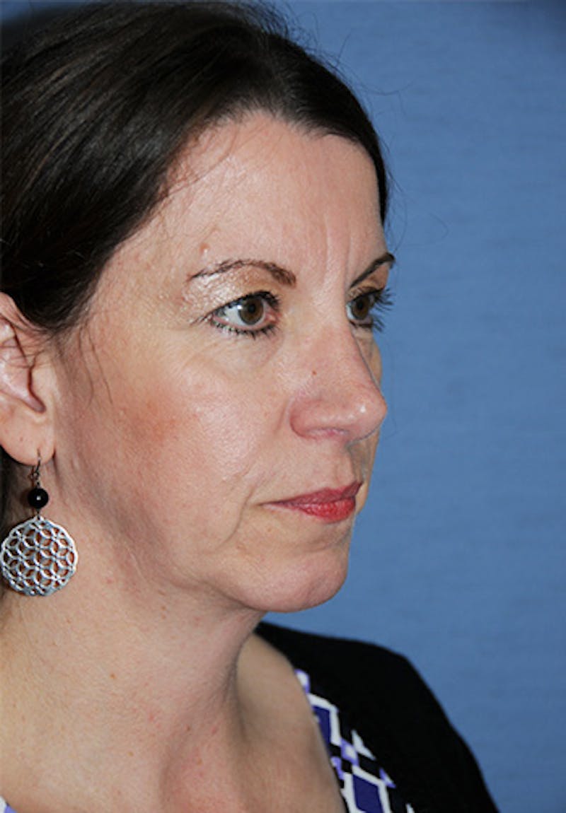 Chin Implant Reshaping Before & After Gallery - Patient 396025 - Image 4