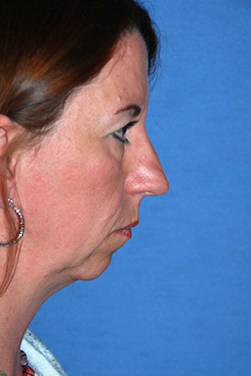 Chin Implant Reshaping Before & After Gallery - Patient 396025 - Image 5