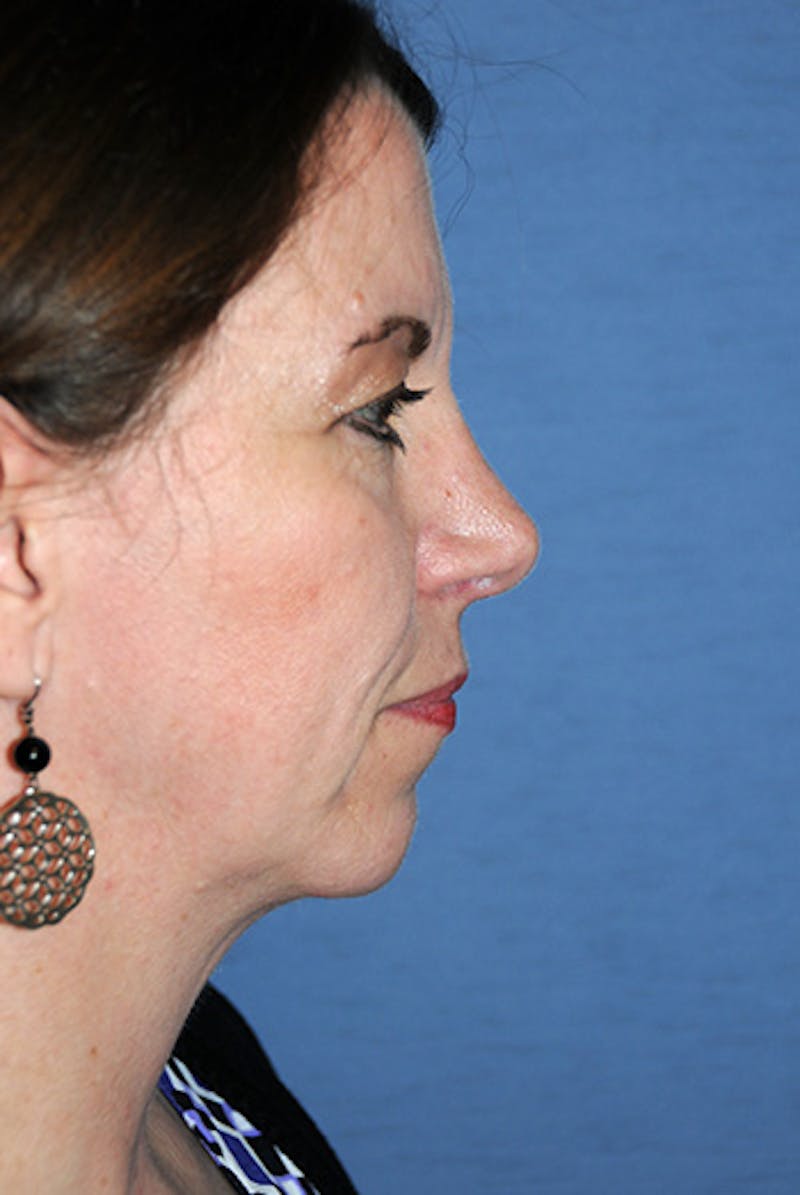 Chin Implant Reshaping Before & After Gallery - Patient 396025 - Image 6