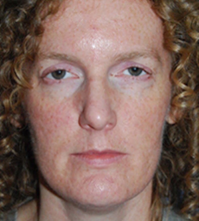 Chin Implant Reshaping Before & After Gallery - Patient 258148 - Image 1