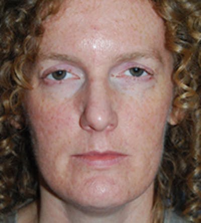 Chin Implant Reshaping Before & After Gallery - Patient 258148 - Image 1