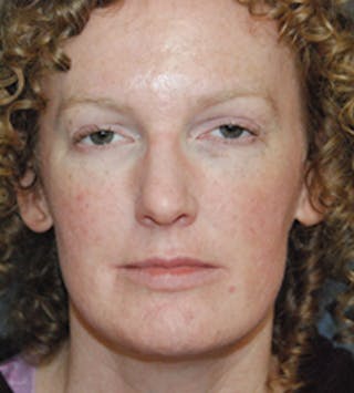 Chin Implant Reshaping Before & After Gallery - Patient 258148 - Image 2