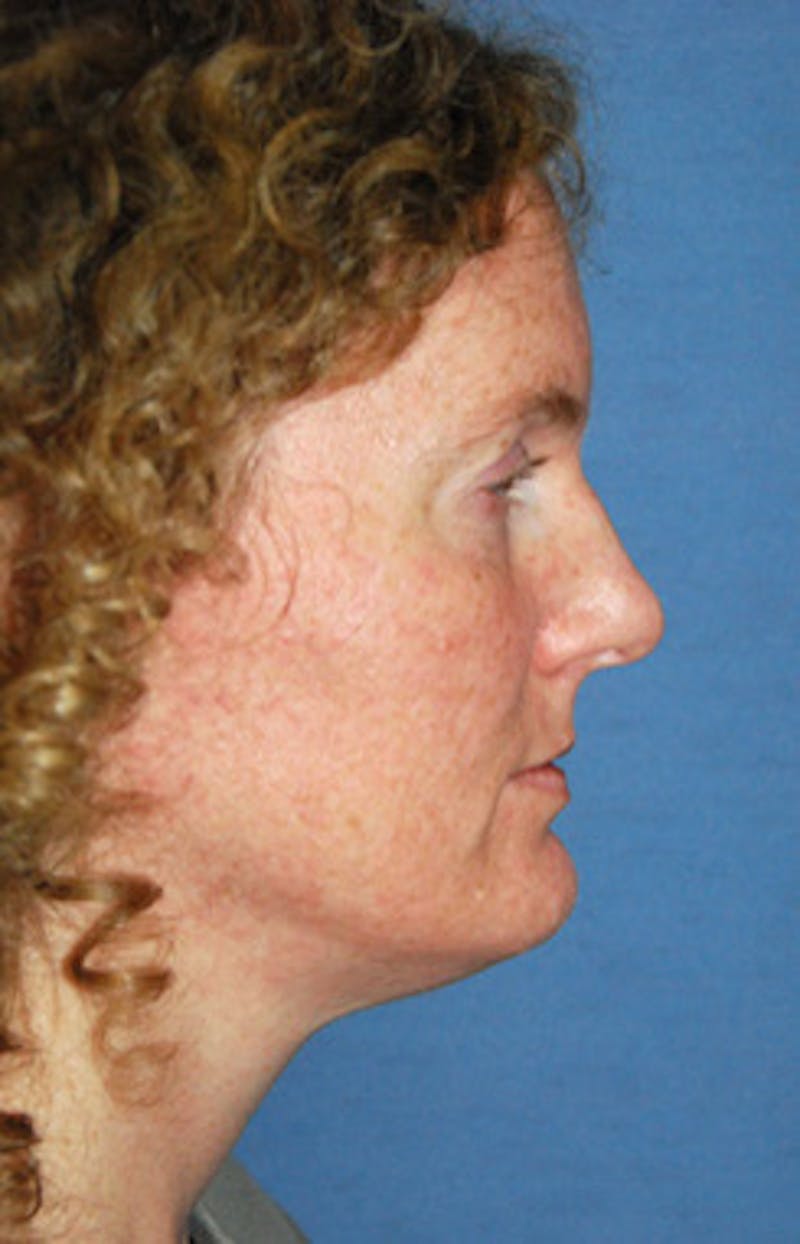 Chin Implant Reshaping Before & After Gallery - Patient 258148 - Image 3