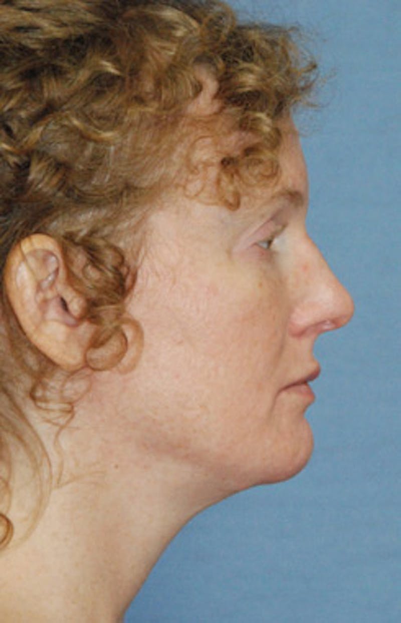 Chin Implant Reshaping Before & After Gallery - Patient 258148 - Image 4