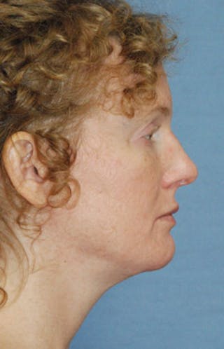 Chin Implant Reshaping Before & After Gallery - Patient 258148 - Image 4