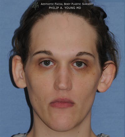 Ear Otoplasty Before & After Gallery - Patient 223855 - Image 1