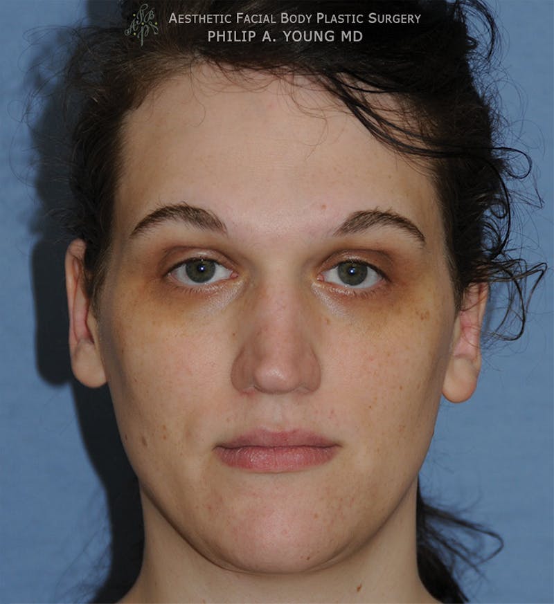 Ear Otoplasty Before & After Gallery - Patient 223855 - Image 2