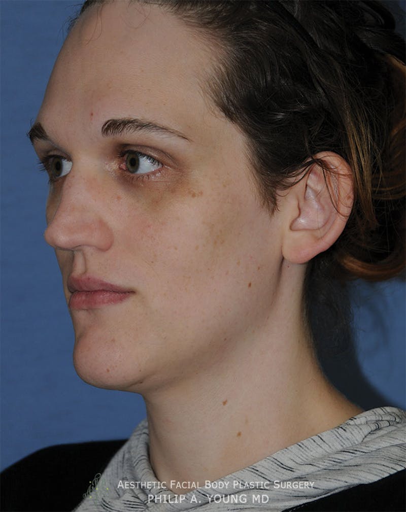 Ear Otoplasty Before & After Gallery - Patient 223855 - Image 3