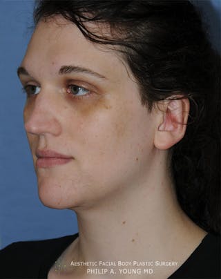 Ear Otoplasty Before & After Gallery - Patient 223855 - Image 4