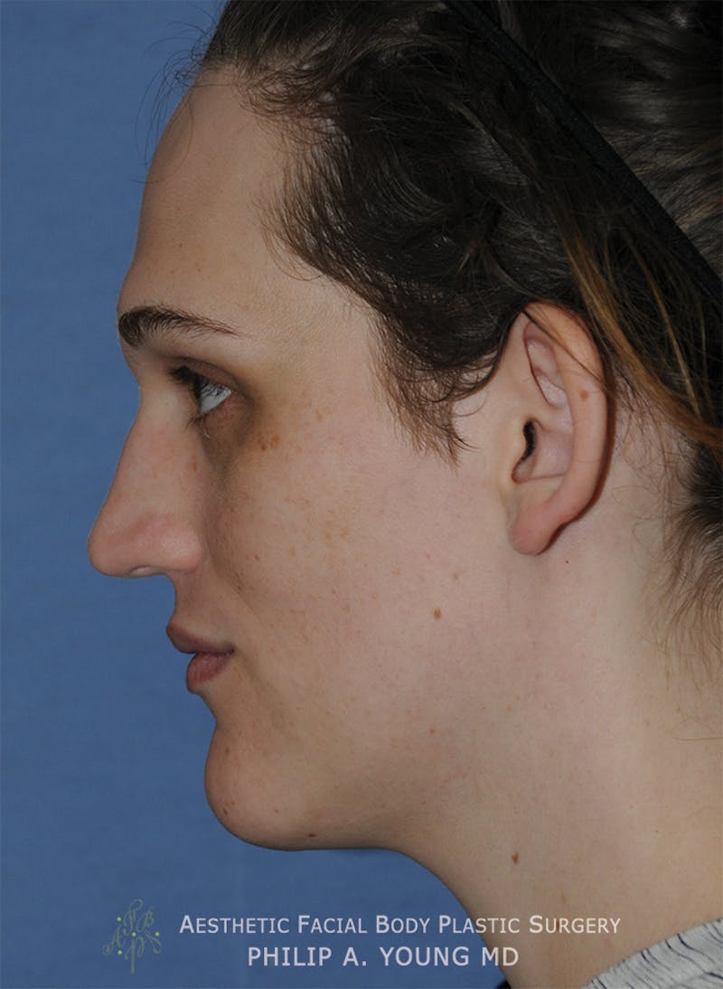 Ear Otoplasty Before & After Gallery - Patient 223855 - Image 5