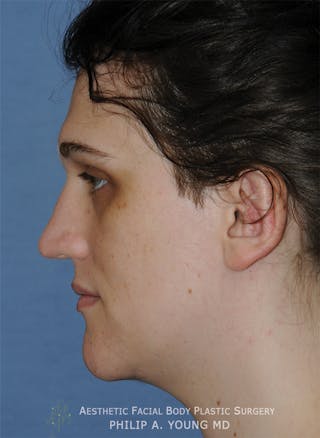 Ear Otoplasty Before & After Gallery - Patient 223855 - Image 6