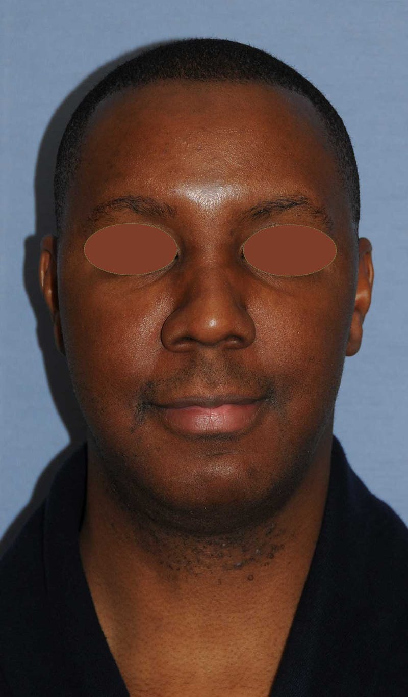 Facial Implants Before & After Gallery - Patient 120851 - Image 1