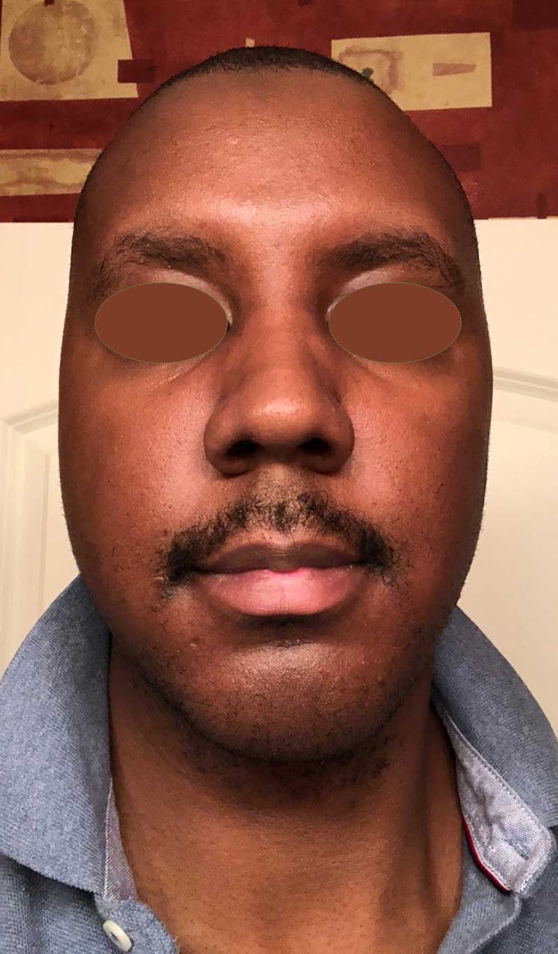 Facial Implants Before & After Gallery - Patient 120851 - Image 2