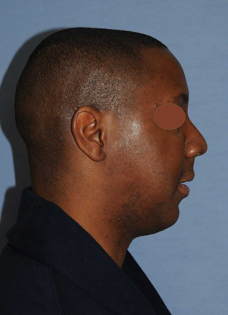 Facial Implants Before & After Gallery - Patient 120851 - Image 3