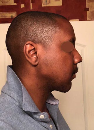 Facial Implants Before & After Gallery - Patient 120851 - Image 4