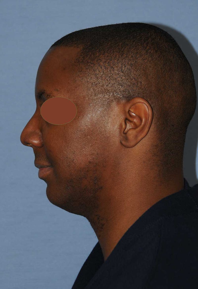 Facial Implants Before & After Gallery - Patient 120851 - Image 5