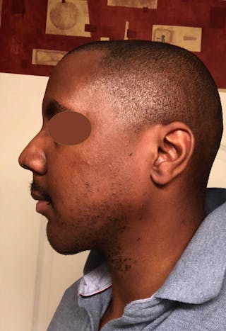 Facial Implants Before & After Gallery - Patient 120851 - Image 6