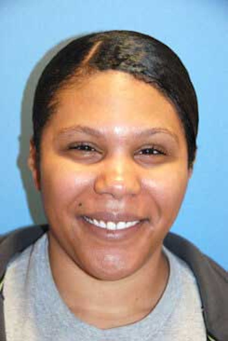 Dimple Creation Before & After Gallery - Patient 386035 - Image 1