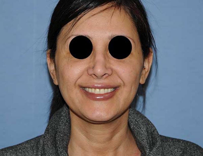 Dimple Creation Before & After Gallery - Patient 246971 - Image 1