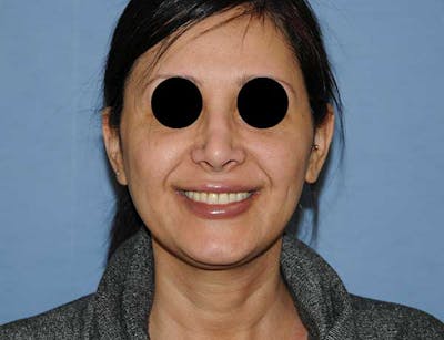 Dimple Creation Before & After Gallery - Patient 246971 - Image 1