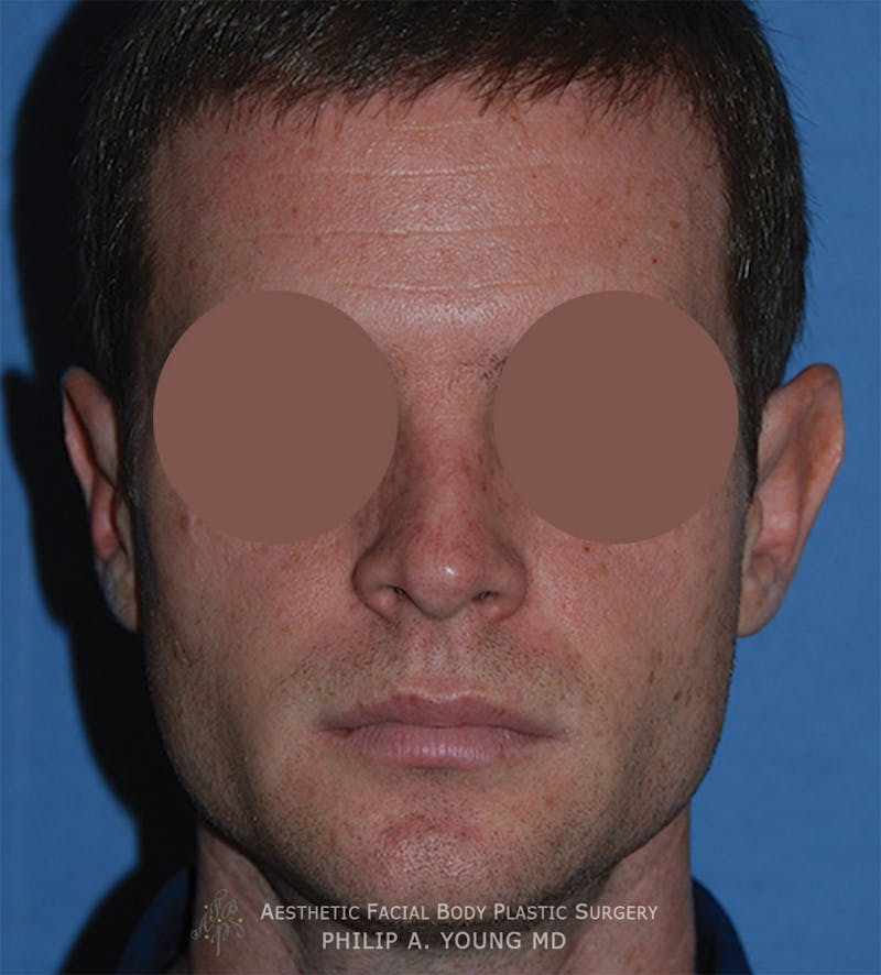 Ear Otoplasty Before & After Gallery - Patient 412030 - Image 1