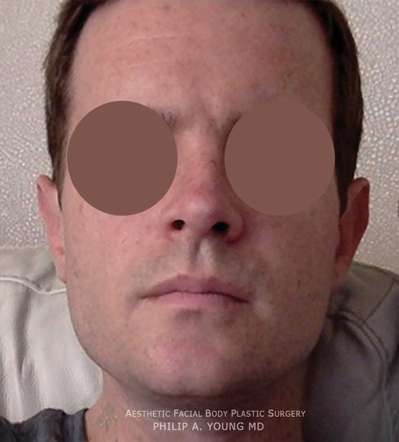 Ear Otoplasty Before & After Gallery - Patient 412030 - Image 2