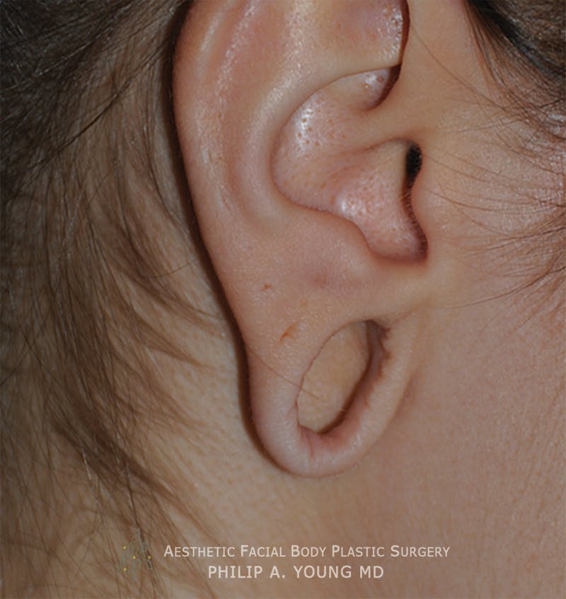Ear Otoplasty Before & After Gallery - Patient 147764 - Image 1