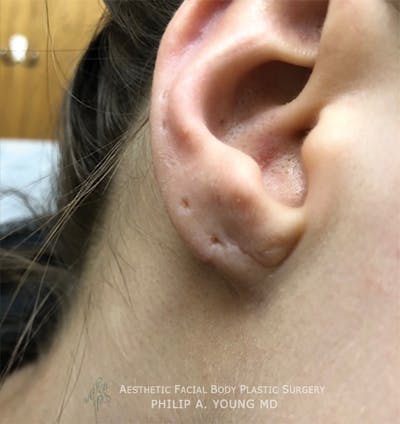 Ear Otoplasty Before & After Gallery - Patient 147764 - Image 2