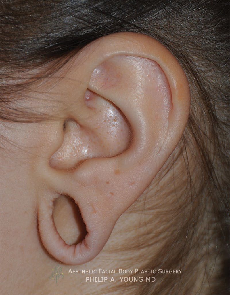 Ear Otoplasty Before & After Gallery - Patient 147764 - Image 3
