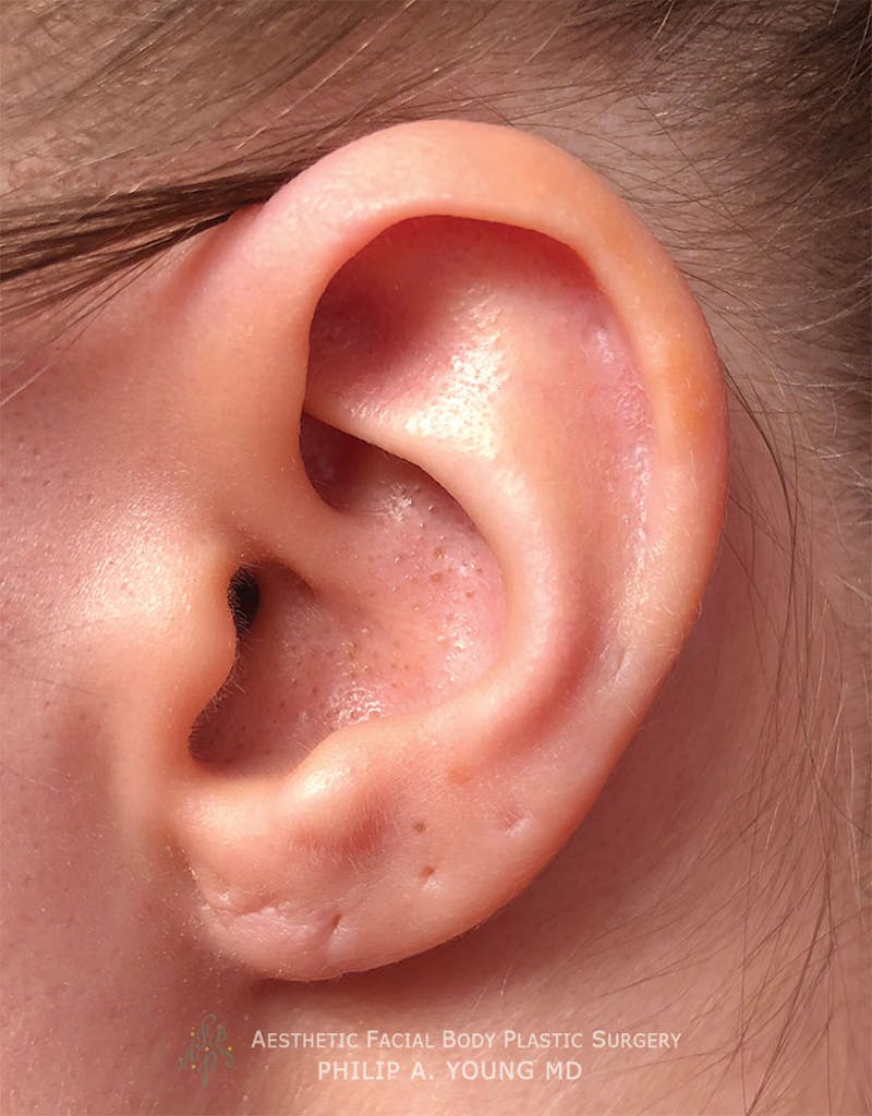 Ear Otoplasty Before & After Gallery - Patient 147764 - Image 4