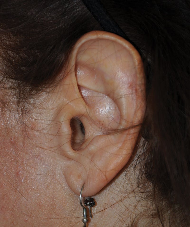 Ear Otoplasty Before & After Gallery - Patient 280758 - Image 1