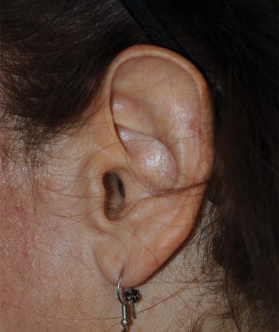 Ear Otoplasty Before & After Gallery - Patient 280758 - Image 1