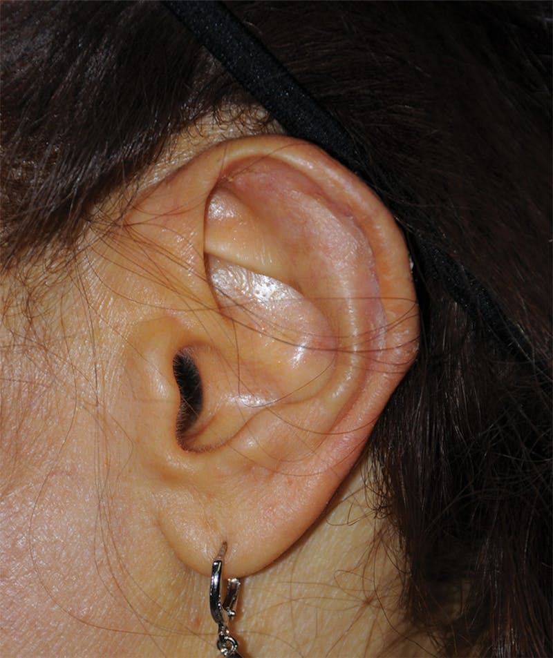 Ear Otoplasty Before & After Gallery - Patient 280758 - Image 2