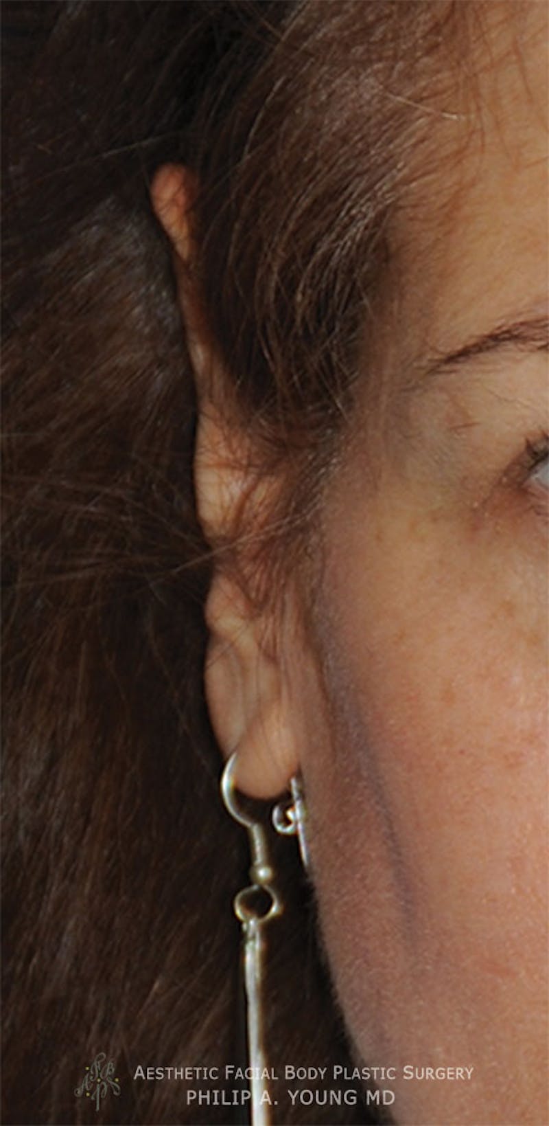 Ear Otoplasty Before & After Gallery - Patient 228295 - Image 1