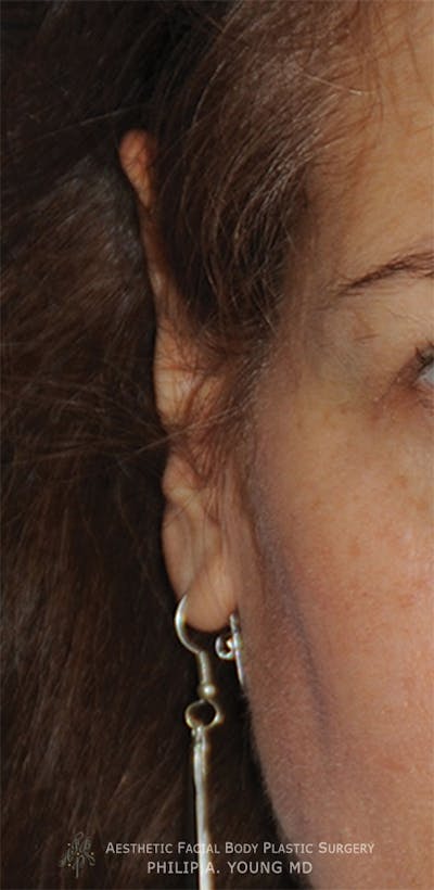Ear Otoplasty Before & After Gallery - Patient 228295 - Image 1