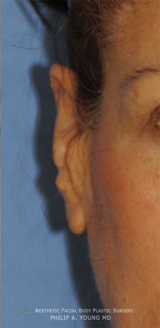 Ear Otoplasty Before & After Gallery - Patient 228295 - Image 2