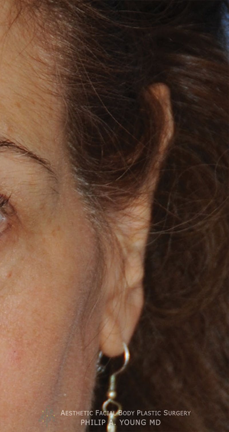 Ear Otoplasty Before & After Gallery - Patient 228295 - Image 3