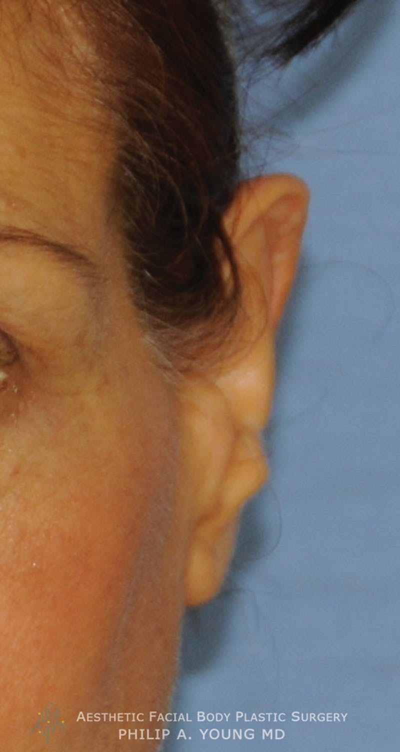 Ear Otoplasty Before & After Gallery - Patient 228295 - Image 4